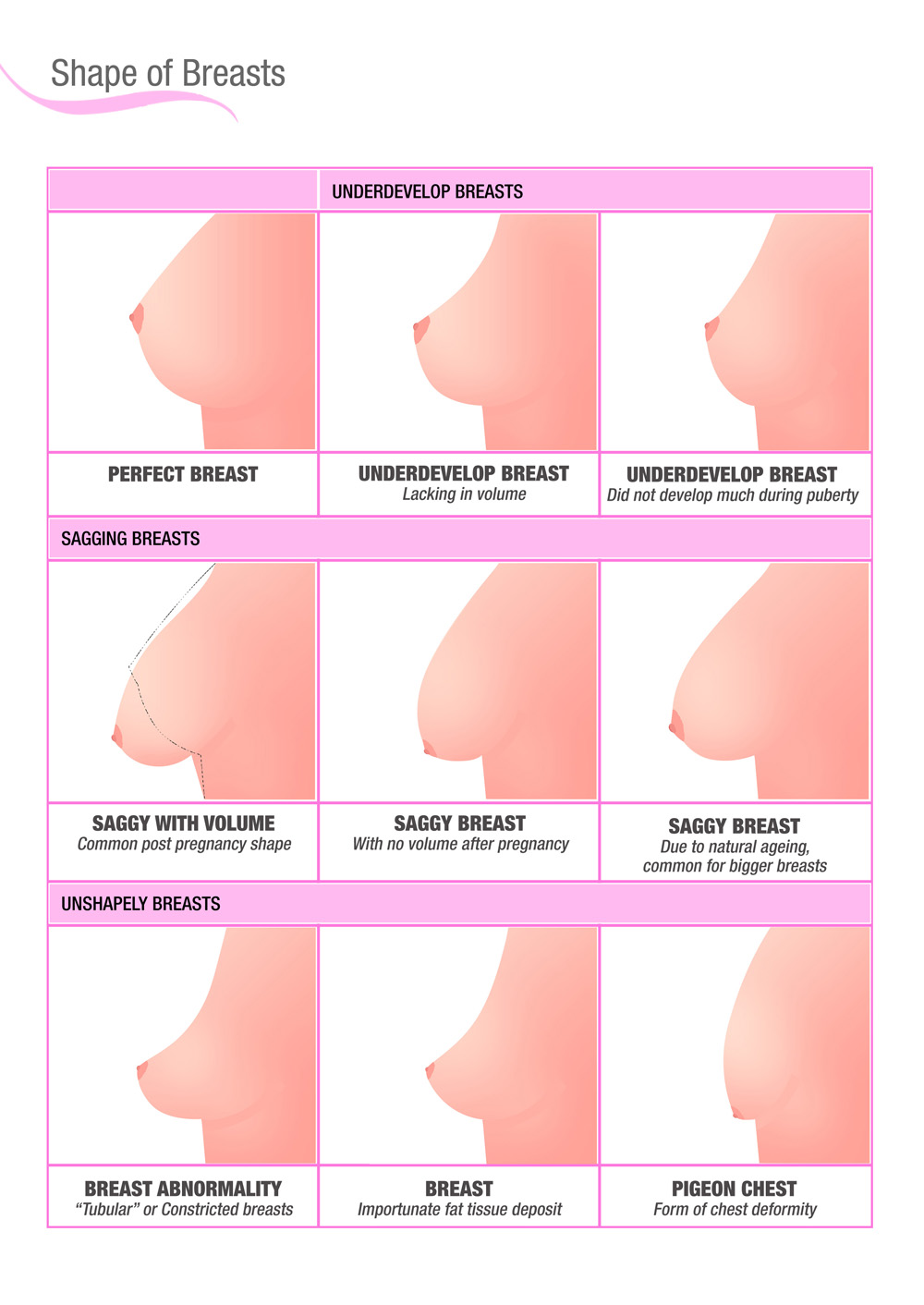 разновидности груди женщин фото 115